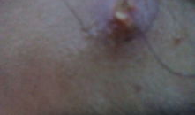 挤火疖子视频,揭秘民间传统疗法的神奇过程