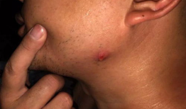 挤火疖子视频,揭秘民间传统疗法的神奇过程